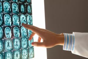 Traumatic Brain Injuries